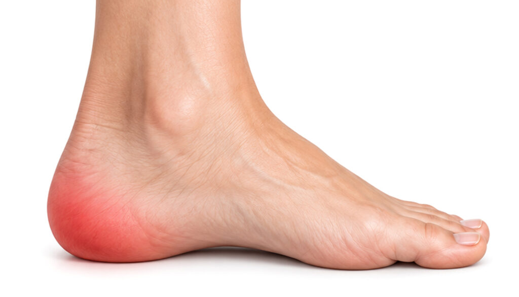 Foot with the painful heel highlighted in red to illustrate heel spurs and heel pain.